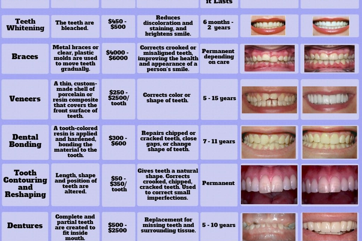 Aligner Staging