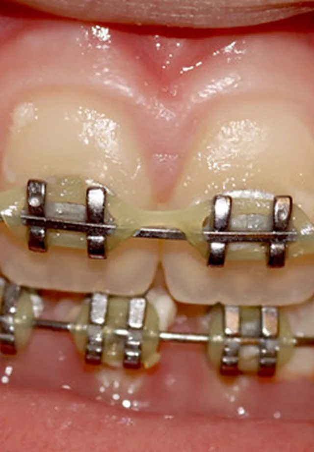 Pre-restorative setup - 3x